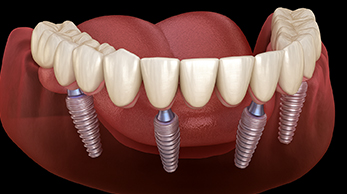 임플란트 재수술