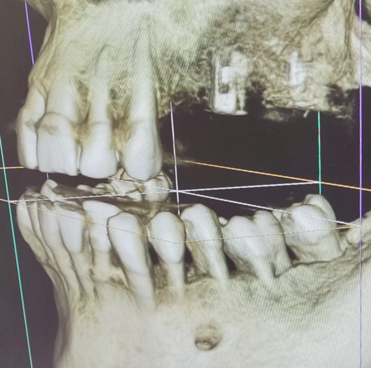 임플란트 엑스레이