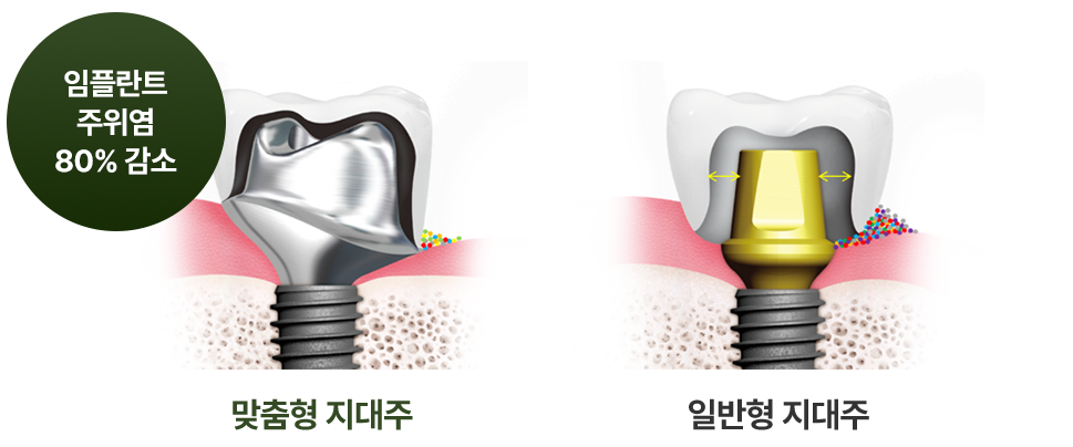 맞춤형 임플란트