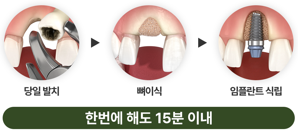 발치즉시 임플란트
